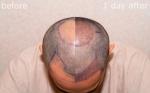 Hair Transplant in the UK